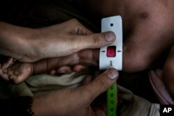 Staff measure the middle upper arm of Salima Ahmed Koryat, a 6-month-old Yemeni girl, to test how malnourished she is at the main hospital in Mocha, Yemen, Feb. 10, 2018.
