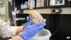 Researcher who studies brain diseases holds a human brain in laboratory at Northwestern University in the United States. 