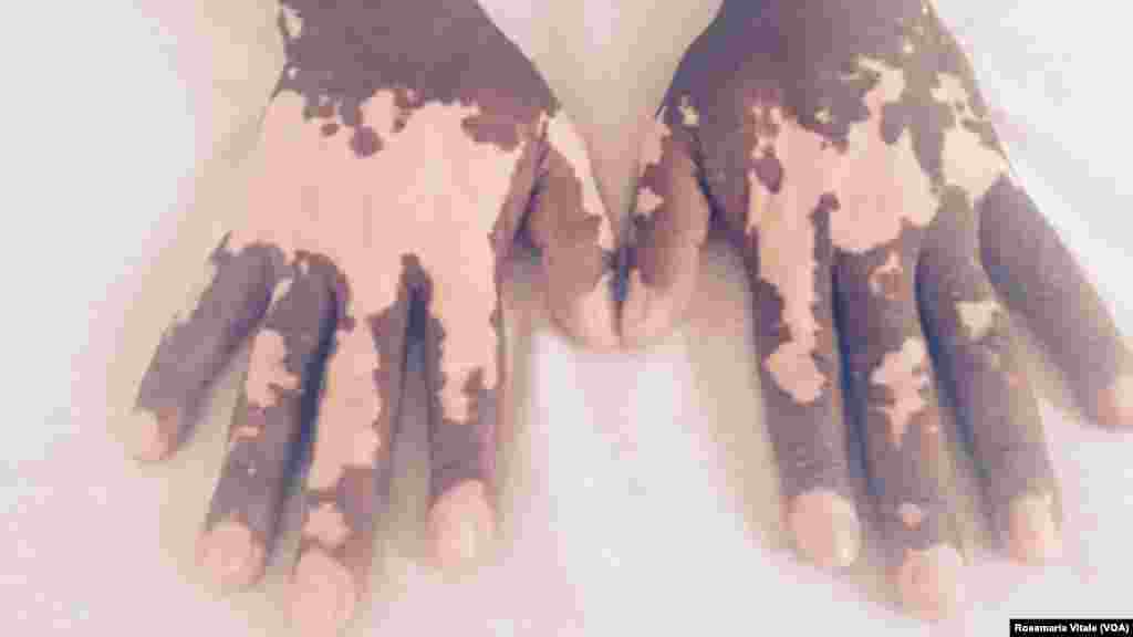 'Yan sumoga sun kona hannun wannan mutumin a yayin da suke kokarin tsallakawa da shi zuwa Turai daga kasar Libya. VOA ta samu wannan hoton ne daga hannun wani dan kasar Italiya dake jinyar baki 'yan ci rani a birnin Milan a kasar Italiya.